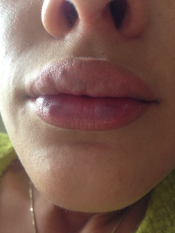 Фото 1. Увеличение губ