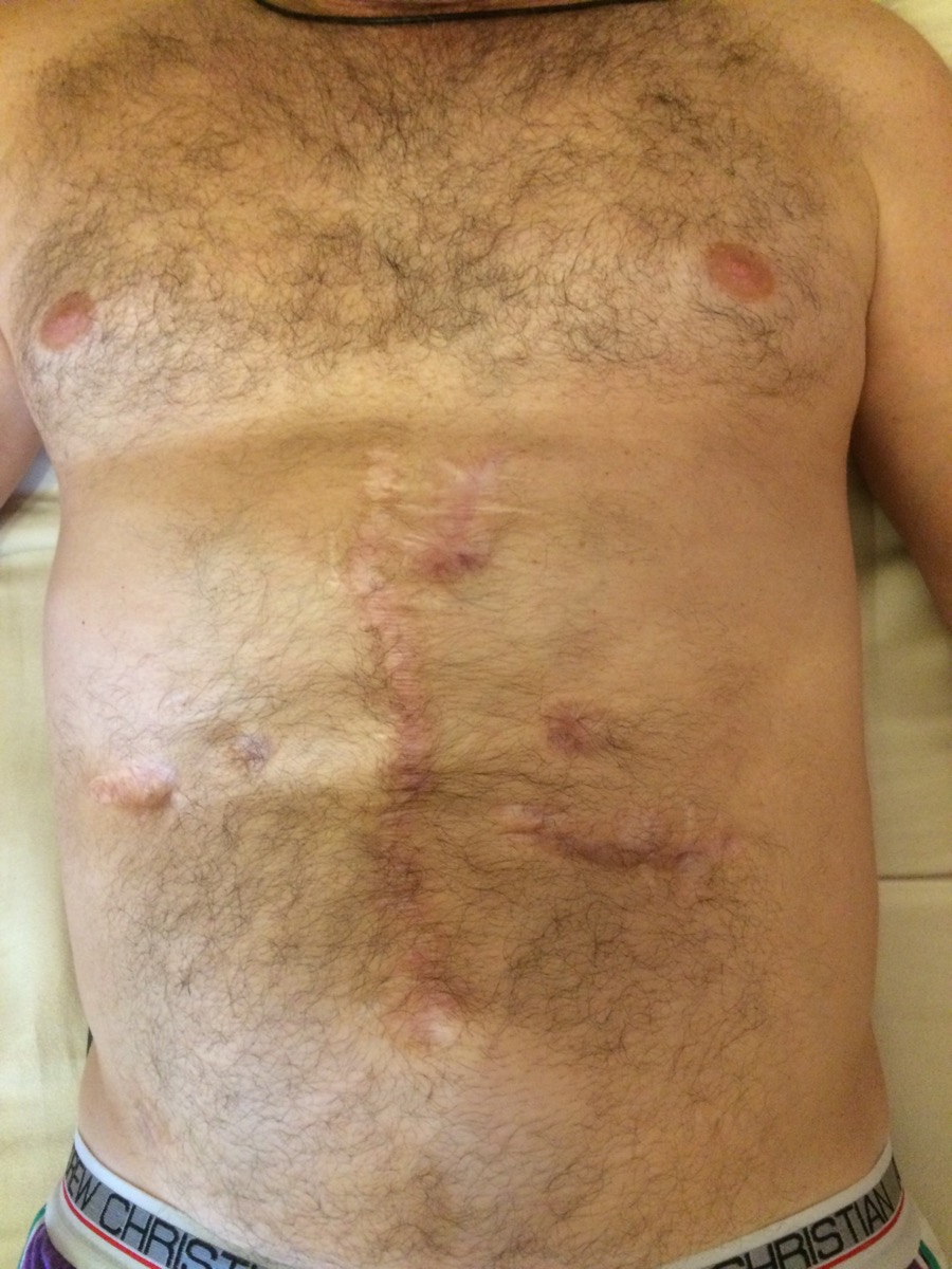 Фото 1. Рубцы на животе после операции