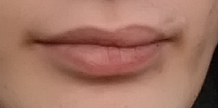 Фото 2. Асимметрия губы после трамвы