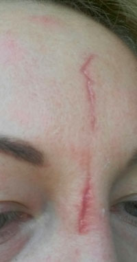 Фото 1. как лечить атрофический рубец на лице?