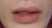 Фото 1. Асимметрия губы после трамвы