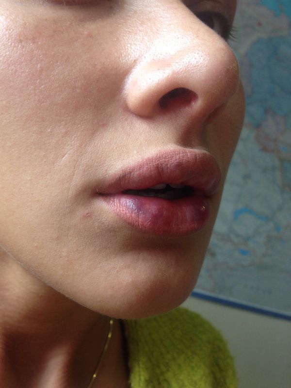 Фото 3. Увеличение губ