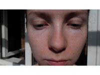 Фото 3. Мимические морщины вокруг глаз