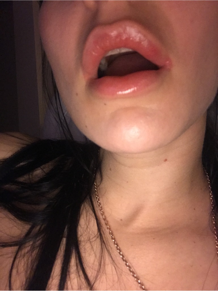 Фото 1. Уплотнение с пузырьком на губе после genial volume