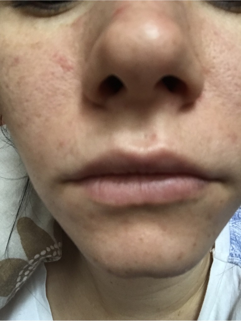 Фото 2. Шарики на губе после гиалуронки спустя 2 недели. Стоит ли переживать в моем случае?