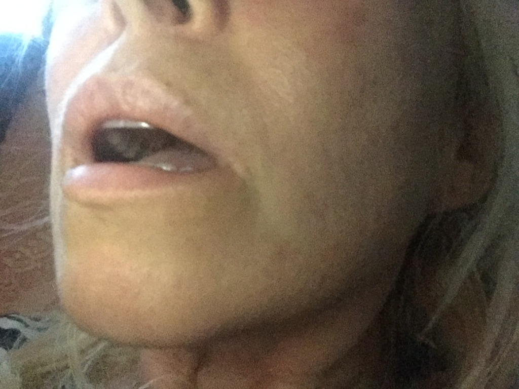 Фото 1. Как сделать восстановление губы после неудачной операции?