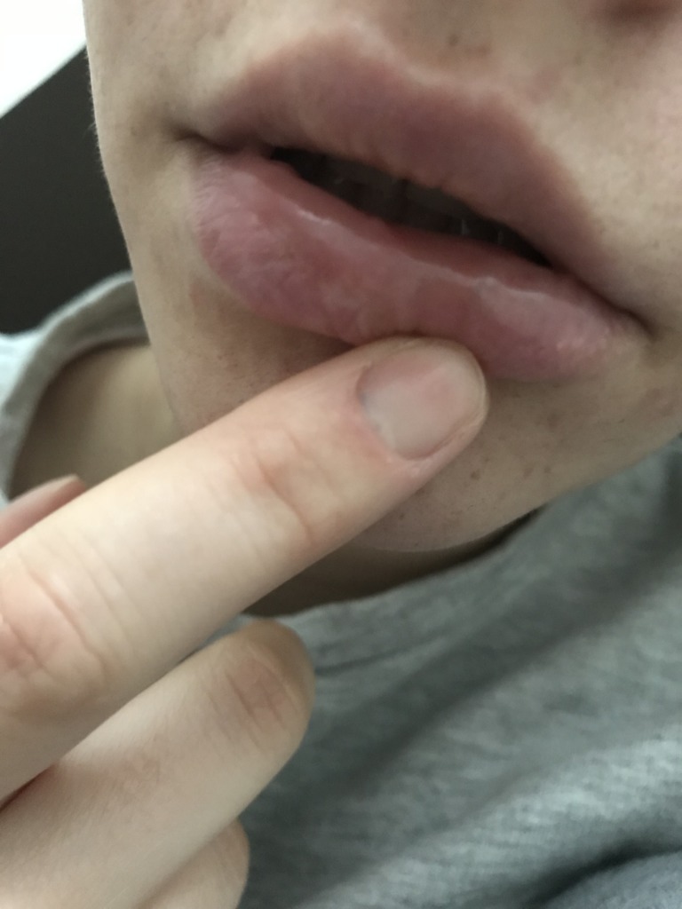 Фото 1. Шарики на губе после гиалуронки спустя 2 недели. Стоит ли переживать в моем случае?