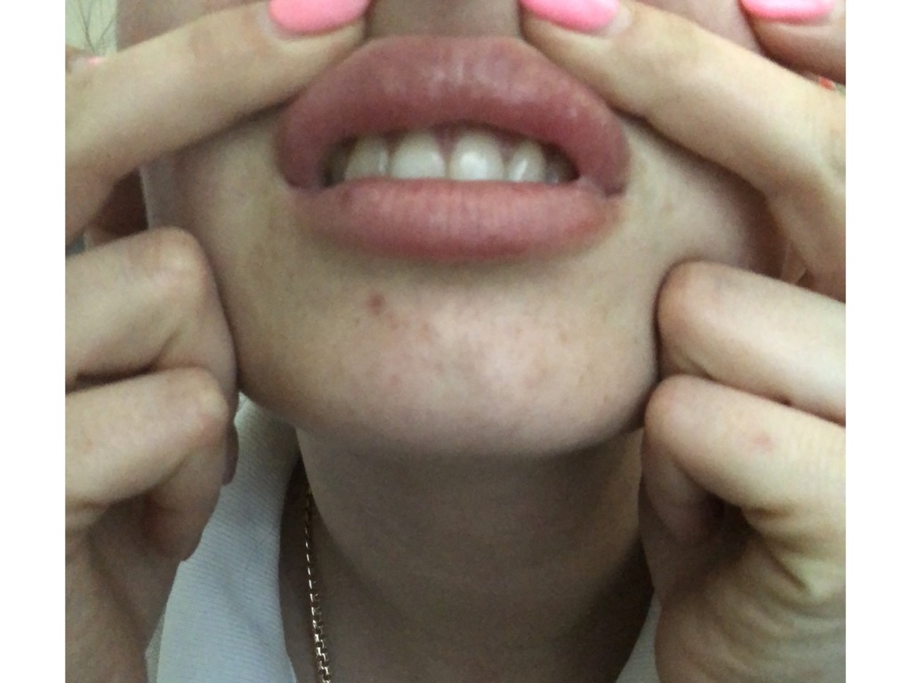 Фото 2. Уплотнения в губе после увеличения филлером