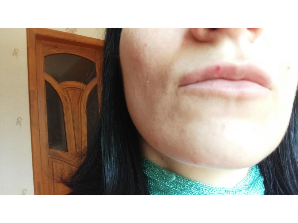 Фото 1. Небольшое красное пятно, которое теплее поверхности губ после гиалуронки через месяц, что это и что мне предпринять?