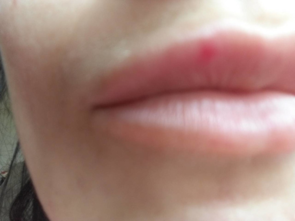 Фото 2. Небольшое красное пятно, которое теплее поверхности губ после гиалуронки через месяц, что это и что мне предпринять?