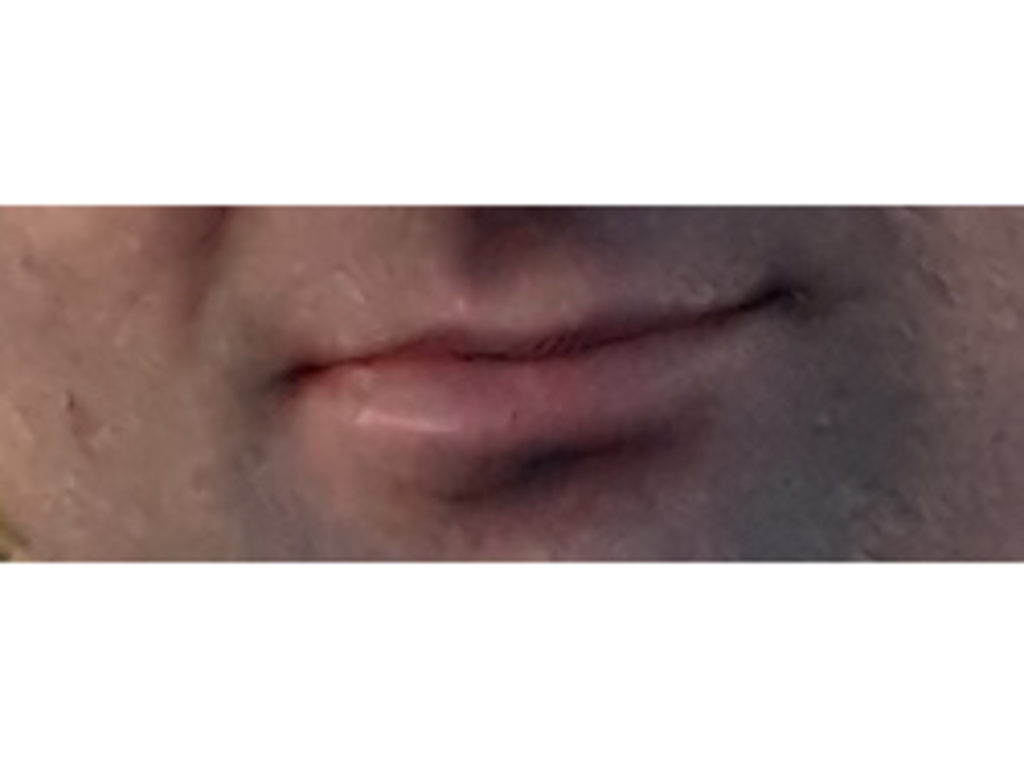 Фото 1. Как вернуть первоначальный вид губы после травмы?