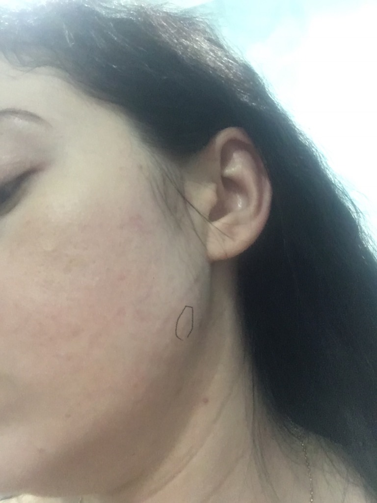 Фото 1. Радисс 1,5 мл, через 5 недель в некоторых местах кожа треснула 
и под отеки под глазами