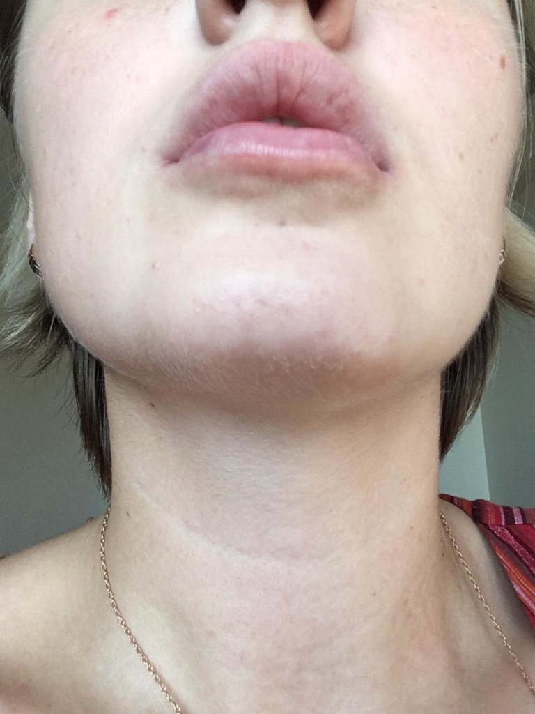 Фото 3. Стоит ли мне колоть лонгидазу в шишки на губах после rejeunesse?