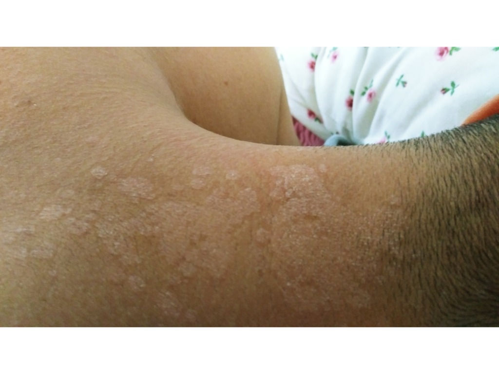 Фото 1. Что это может быть и как лечить такую болезнь кожи?