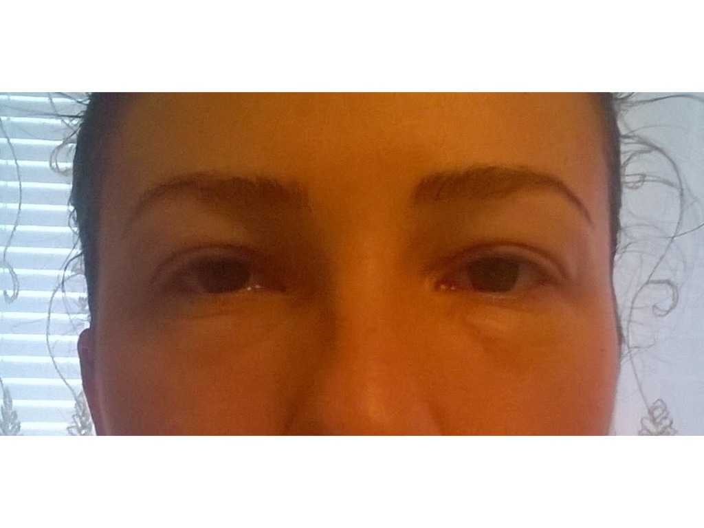 Фото 2. Есть ли смысл делать мезотерапию при выраженных мешках под глазами?