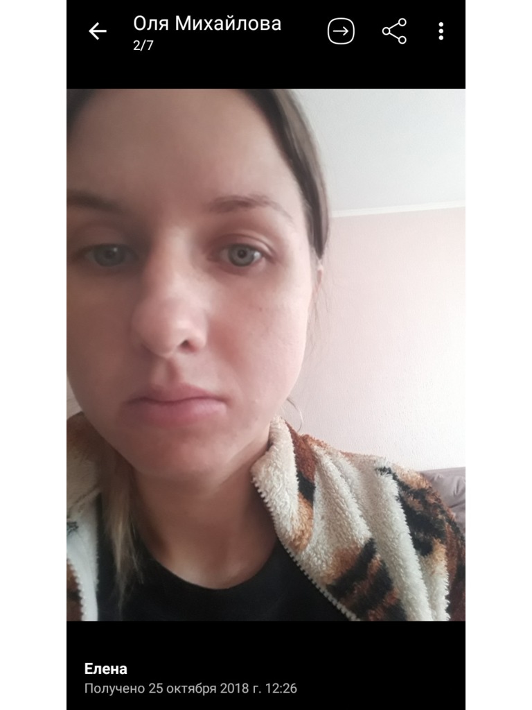 Фото 2. Как избавиться от залома после филлера?