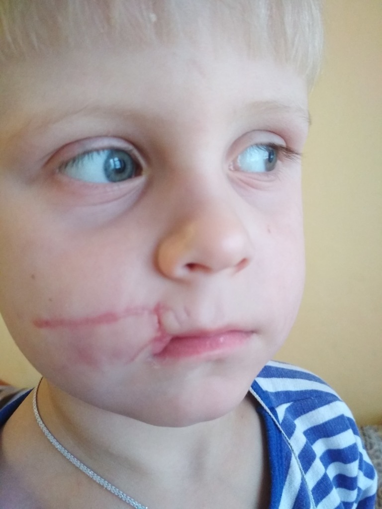 Фото 1. Что делать со шрамом на лице у ребенка?