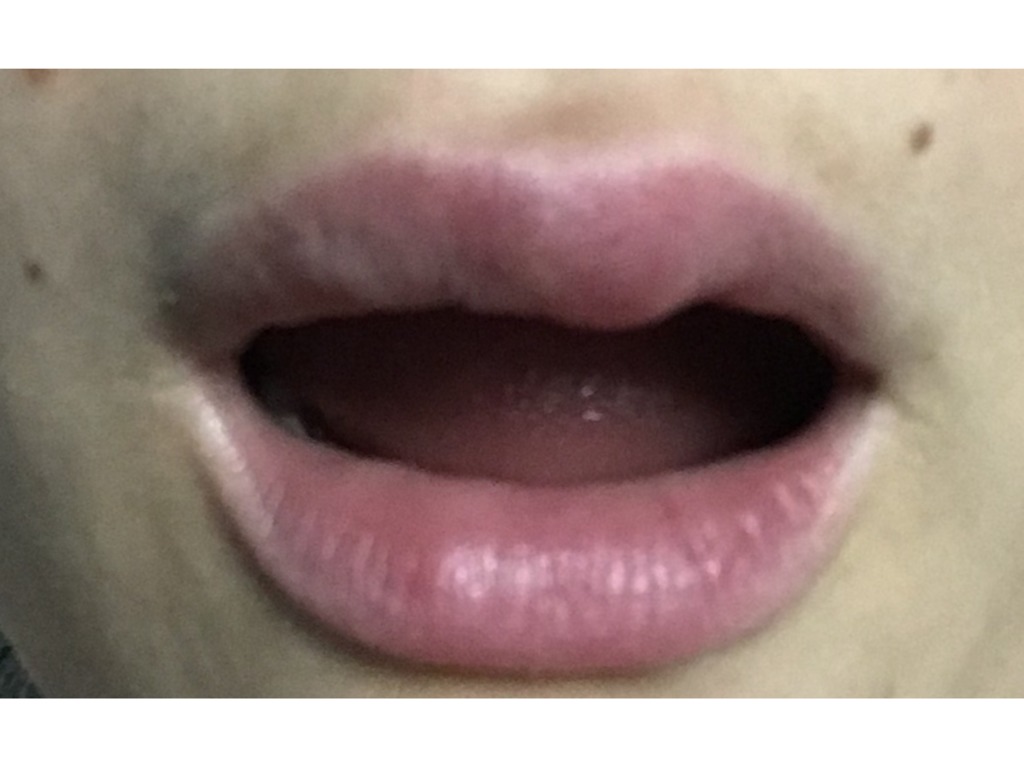 Фото 2. Раздувает губы после увеличения филлером. Что это может быть и связано ли это с гиалуронкой?