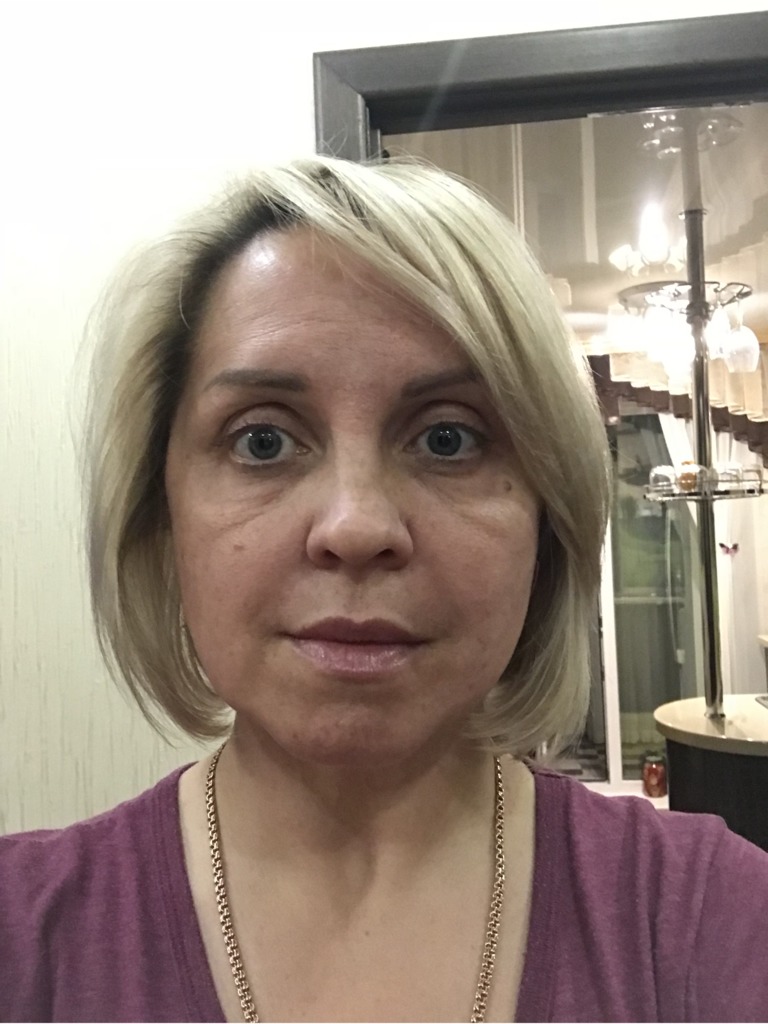 Juvederm hydrate отеки под глазами Juvederm hydrate отеки под глазами thumbnail