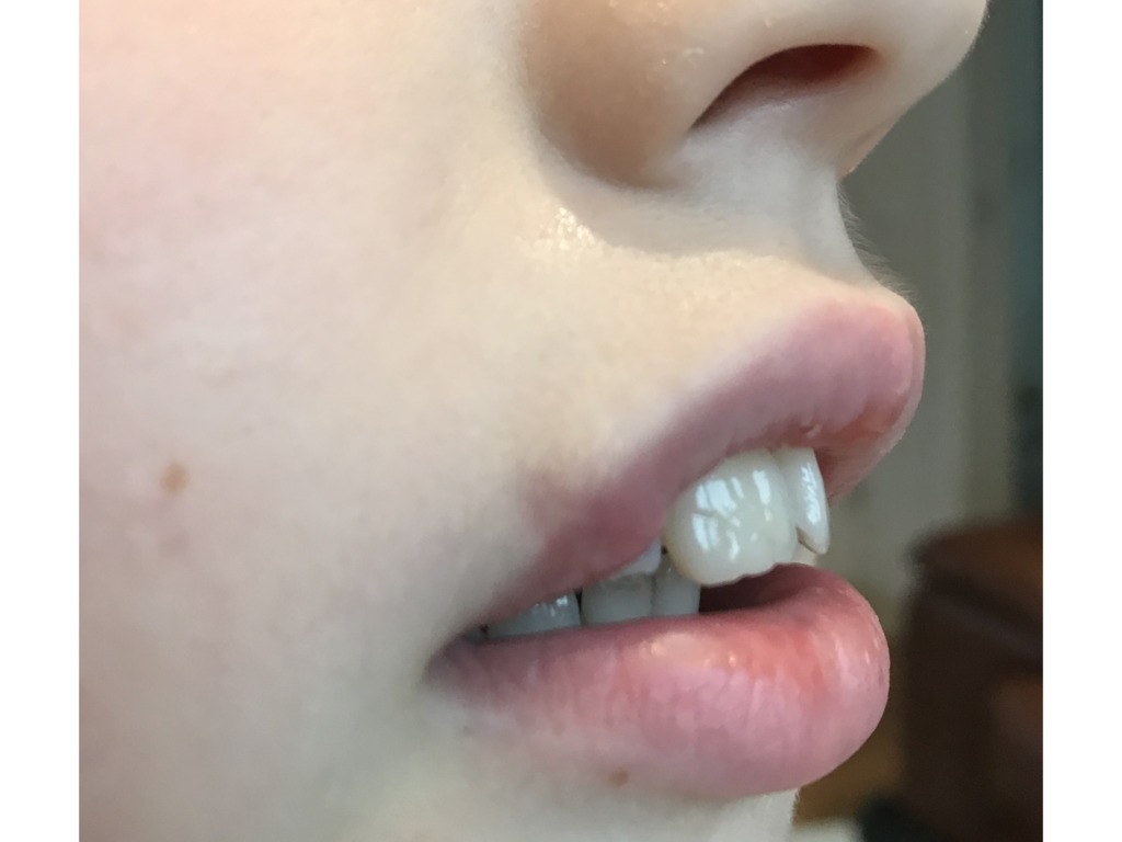 Фото 1. Какая нехирургическая процедура допустима в лечении рубца?