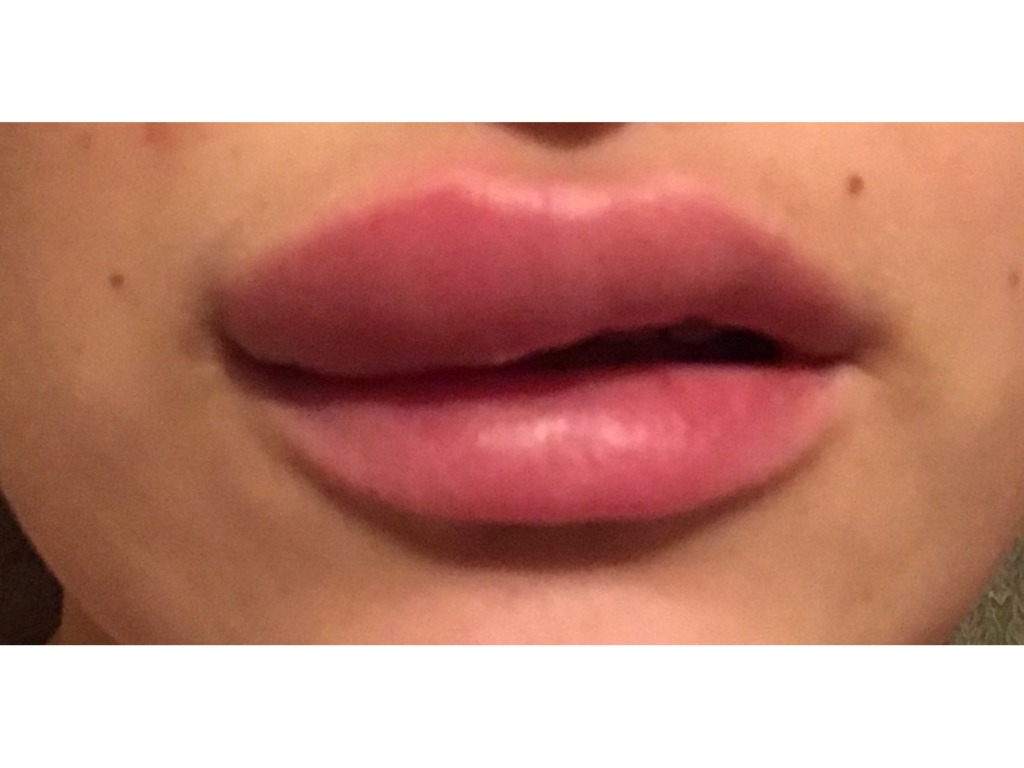 Фото 3. Раздувает губы после увеличения филлером. Что это может быть и связано ли это с гиалуронкой?