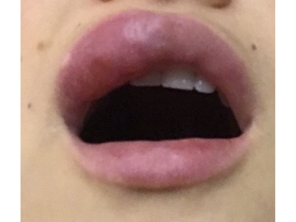 Фото 5. Раздувает губы после увеличения филлером. Что это может быть и связано ли это с гиалуронкой?