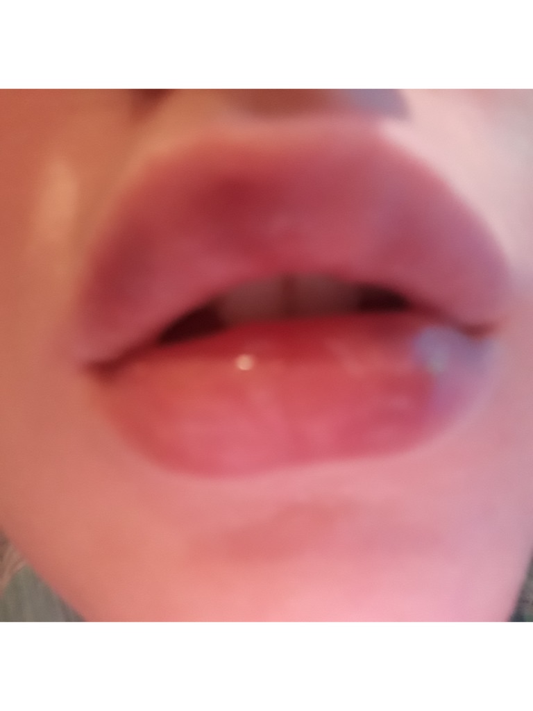 Фото 1. Считается ли нормой комочки и синяки после увеличения губ гиалуроновой кислотой?