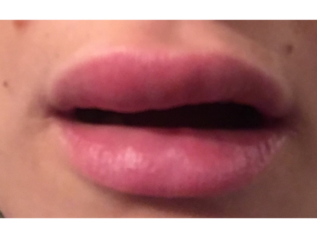 Фото 1. Раздувает губы после увеличения филлером. Что это может быть и связано ли это с гиалуронкой?
