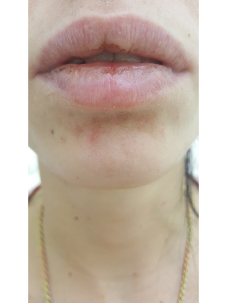 Удаление гранул Фордайса (себорейных кист) на половых губах у женщин