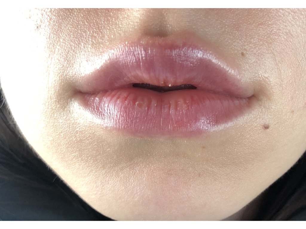 Увеличение губ усы гиалуроновые. Отек над губой после филлера.