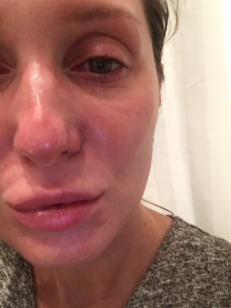 Фото 5. Как быть, если не проходит отечность и заломы в носослезной борозде?