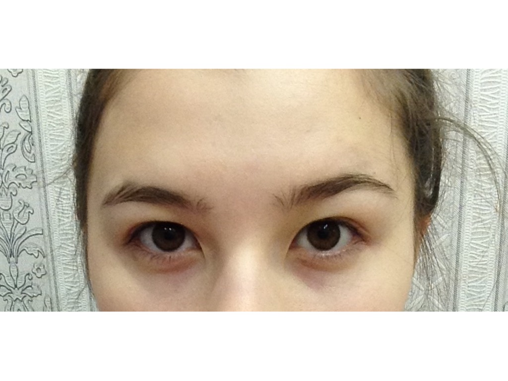 Фото 1. Как сгладить эпикантус и избежать эффекта круглых глаз после операции?