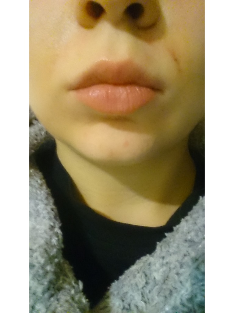 Фото 1. Нормально ли, если чувствуются и болят валики в носогубных складках после ювидерма?