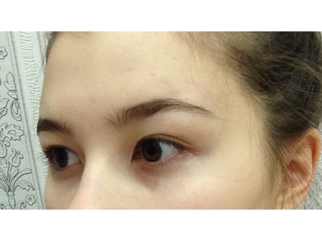Фото 2. Как сгладить эпикантус и избежать эффекта круглых глаз после операции?