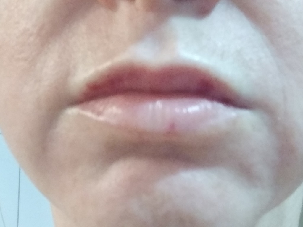 Фото 1. Стоит ли беспокоиться после увеличения губ, если принимаешь неотризол?
