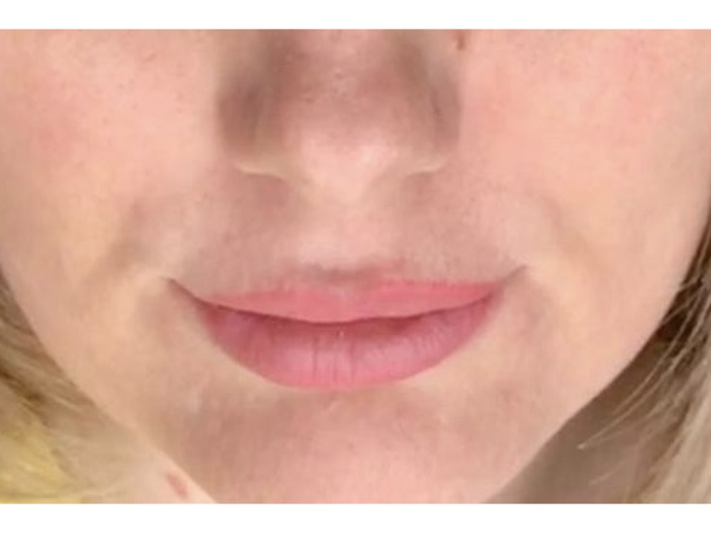 Фото 6. Почему получился такой эффект после филлера и что теперь делать?