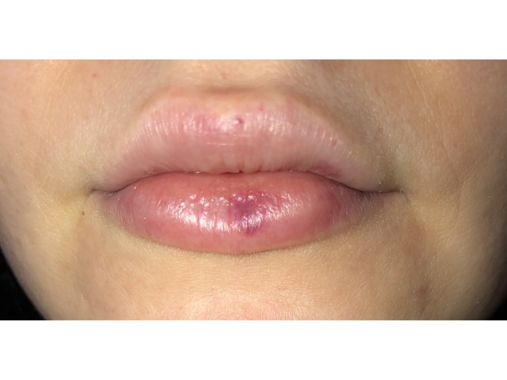 Фото 2. Когда можно оценивать окончательный результат от увеличения губ?