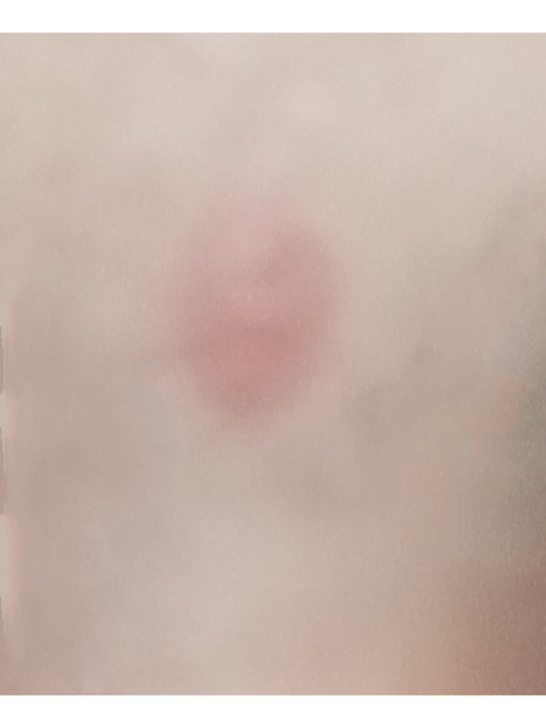 Фото 1. Может ли образоваться рубец после удаления родинки и приемлима ли в этом случае шлифовка?