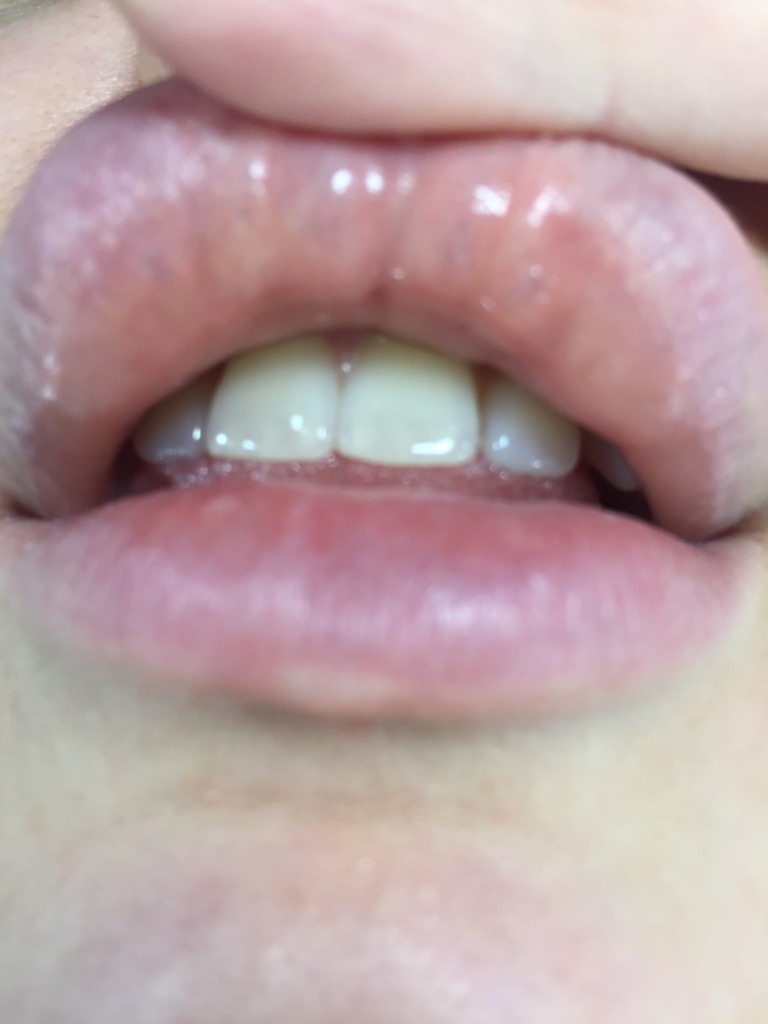 Фото 4. Что могут значить образовавшиеся синие капсулы на губах после филлера?