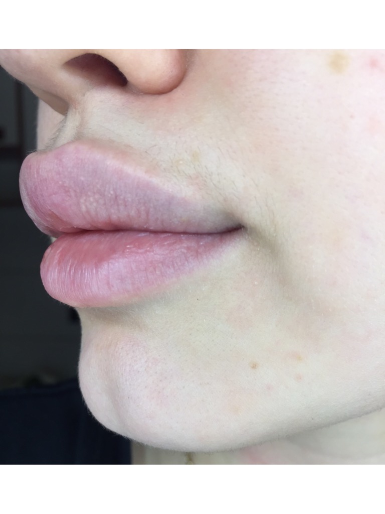 Фото 1. Что могут значить образовавшиеся синие капсулы на губах после филлера?