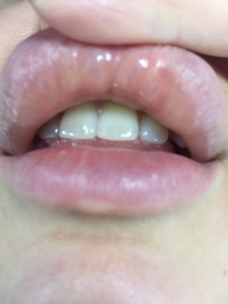 Фото 3. Что могут значить образовавшиеся синие капсулы на губах после филлера?