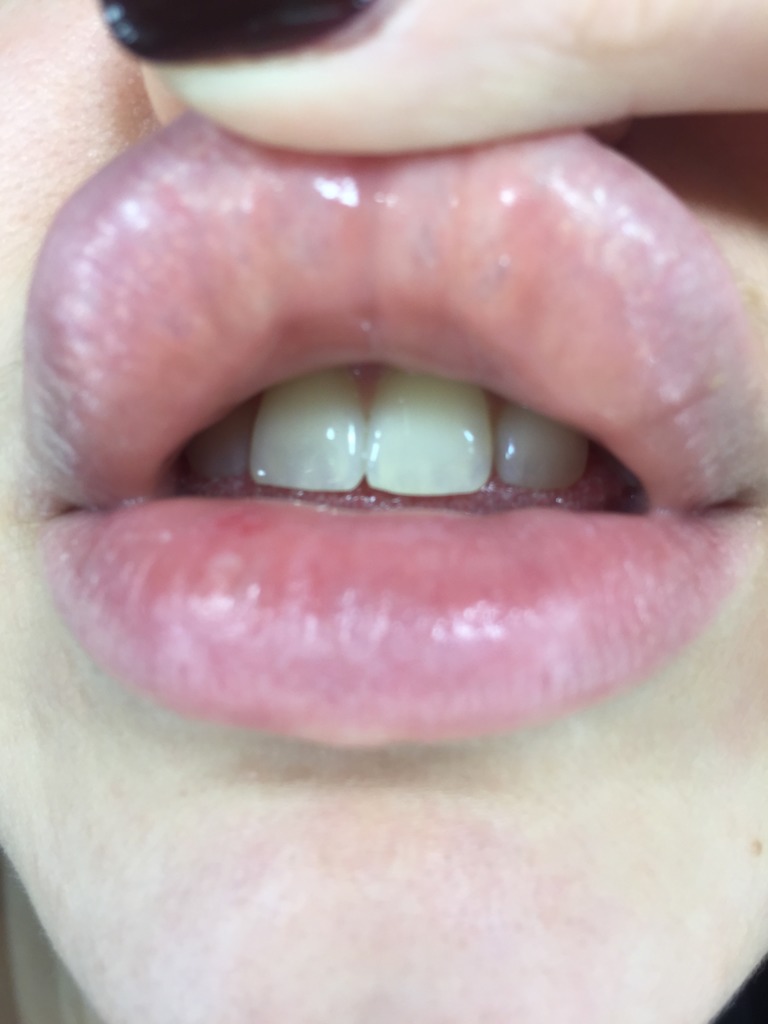 Фото 2. Что могут значить образовавшиеся синие капсулы на губах после филлера?