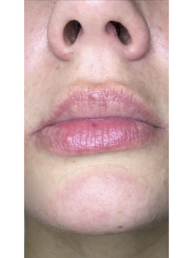 Фото 1. От чего может возникнуть ассиметрия на губах и как ее убрать?