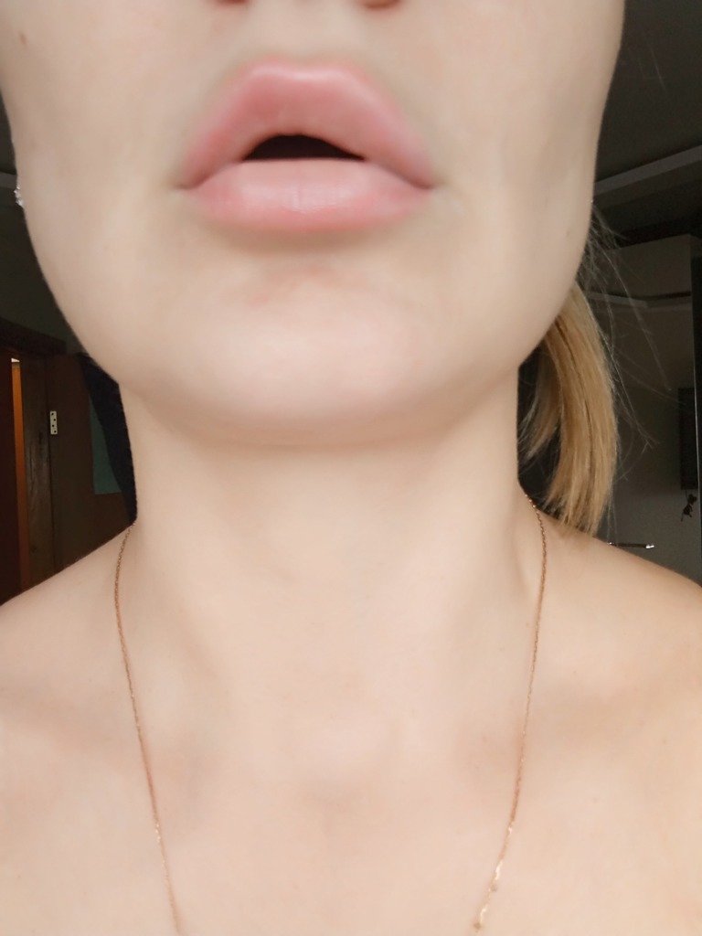 Фото 1. Почему появилось провисание на одной стороне рта после увеличения губ?