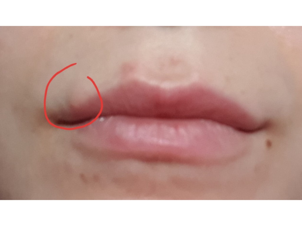 Фото 4. Как убрать шишки, оставшиеся после увеличения губ спустя год?