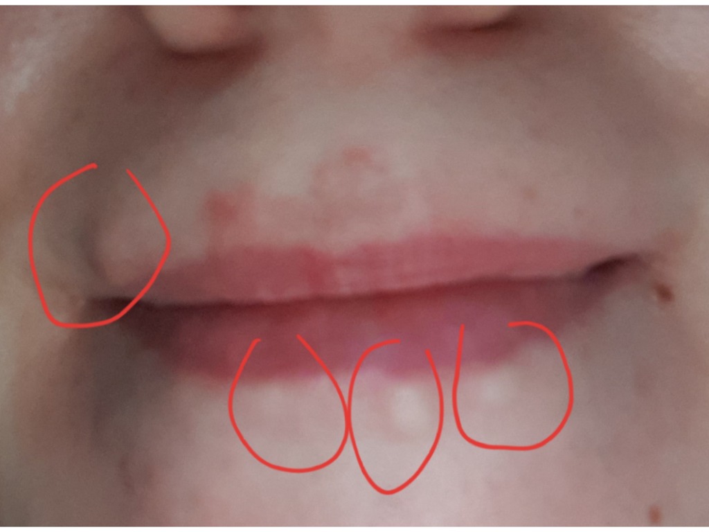 Фото 2. Как убрать шишки, оставшиеся после увеличения губ спустя год?