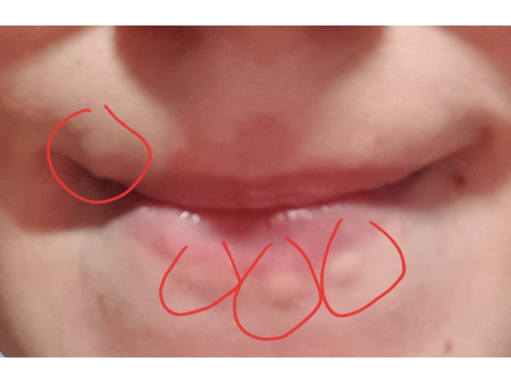 Фото 3. Как убрать шишки, оставшиеся после увеличения губ спустя год?