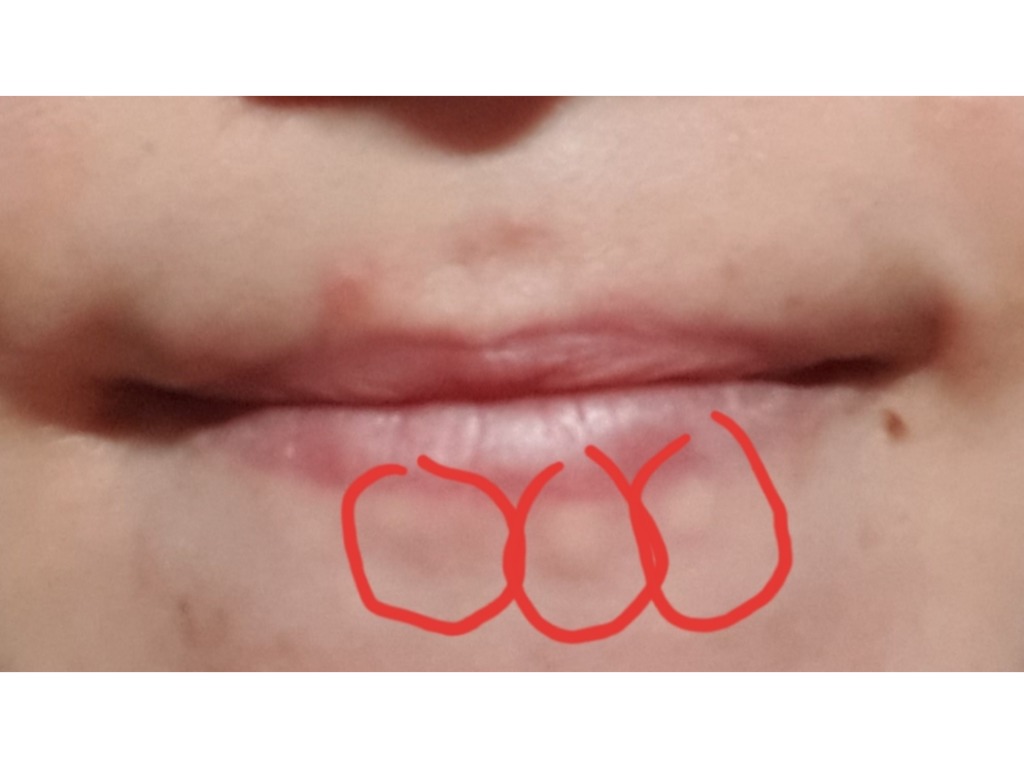 Фото 1. Как убрать шишки, оставшиеся после увеличения губ спустя год?