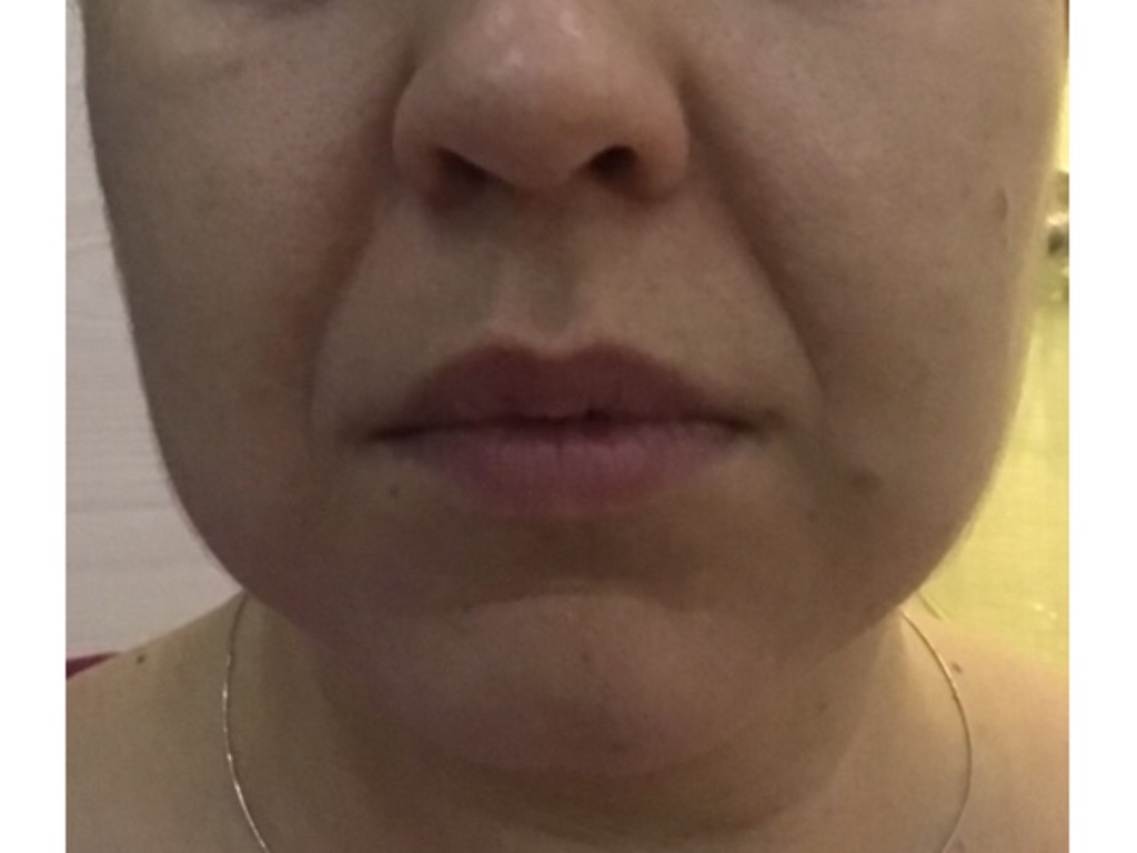 Фото 1. Как избавиться от носогубок?