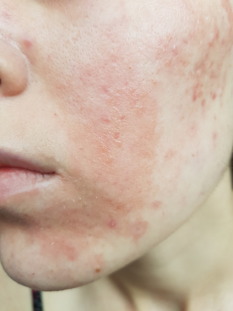 Фото 2. Может ли быть аллергия на плазмолифтинг и как это лечить?